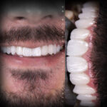 انواع برند و مارک و نوع لمینت دندان در کلینیک دکتر مسعودی