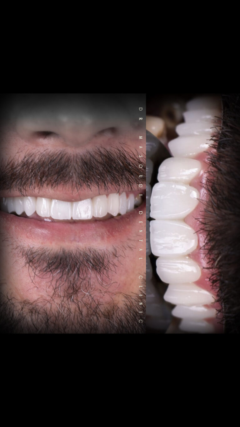 انواع برند و مارک و نوع لمینت دندان در کلینیک دکتر مسعودی