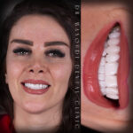 قیمت لمینت سرامیکی دندان 1401