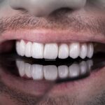 عکس اینفوگرافی مقایسه لمینت دندان و ونیر کامپوزیت دندان