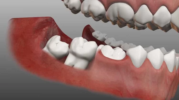 جراحی دندان عقل درکرج چگونه است