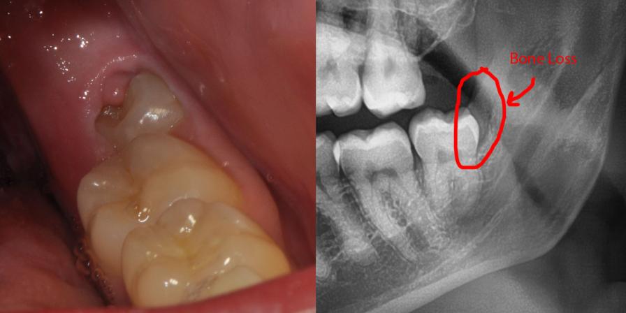 کلینیک دندانپزشکی دکتر مسعودی دندان عقل نهفته در کرج
