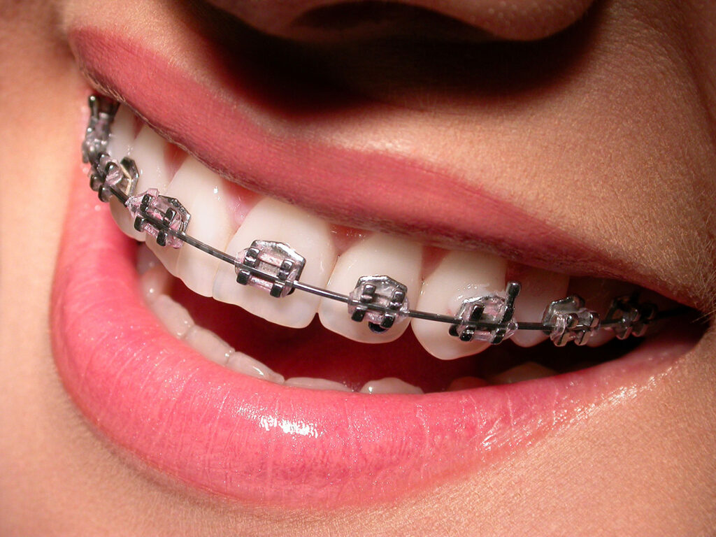 آیا ارتودنسی با دندان عقل ممکن است