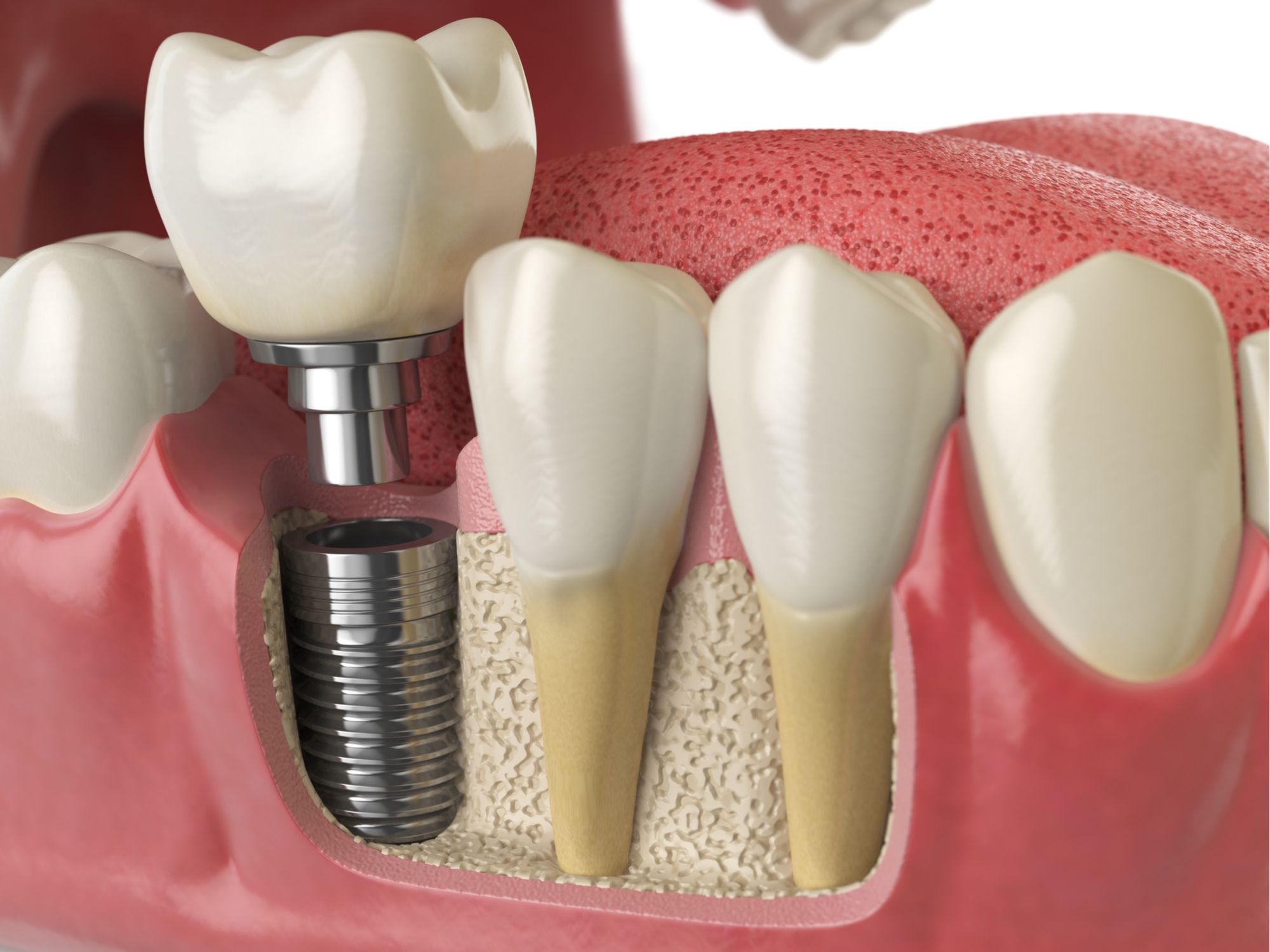 کلینیک دندانپزشکی دکتر مسعودی دستورات بعد از جراحی ایمپلنت