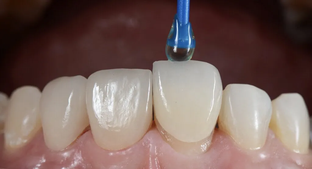 کلینیک دندانپزشکی دکتر مسعودی انواع لمینت دندان