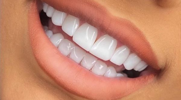 کلینیک دندانپزشکی دکتر مسعودی انواع کامپوزیت دندان