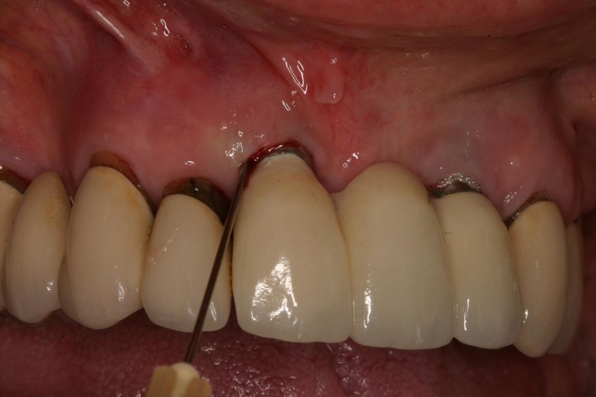 چرا دندان ایمپلنت سیاه میشود