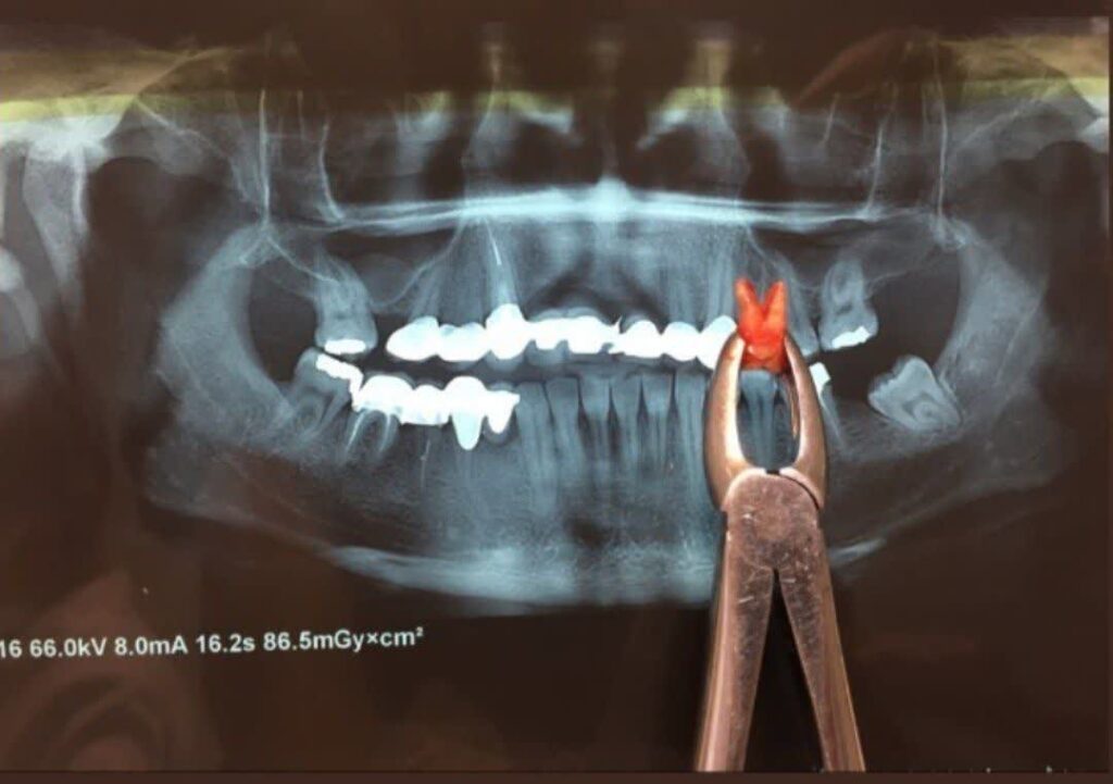 جراحی دندان عقل در کرج
