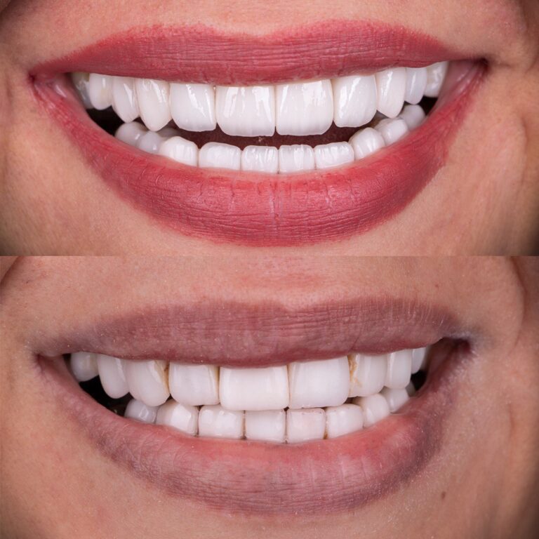 نمونه کار لمینت دندان