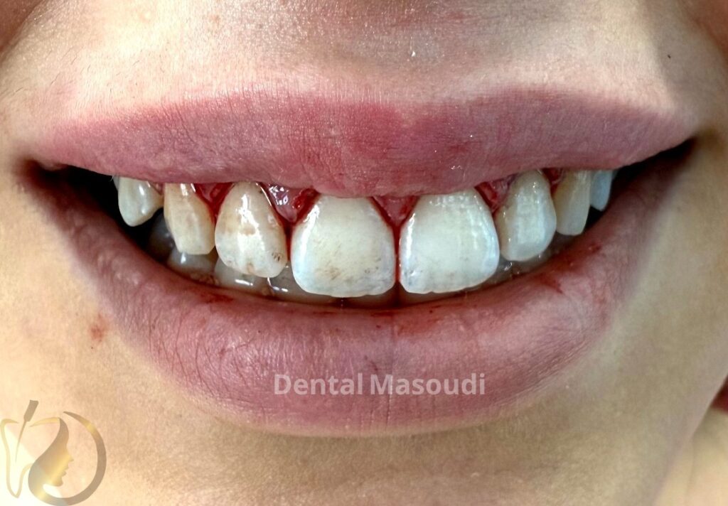 لیفت لثه در کرج