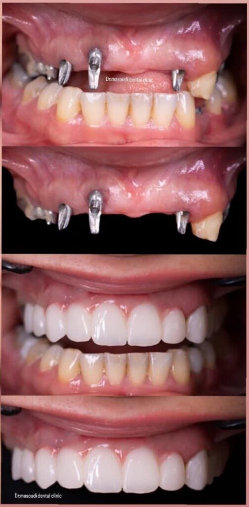 هزینه ایمپلنت دندان در سال ۱۴۰۴ در کرج