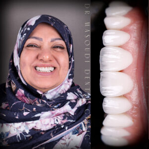 نمونه کار لمینت دندان