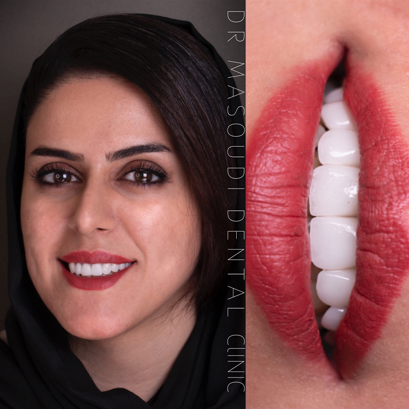 نمونه کار لمینت دندان