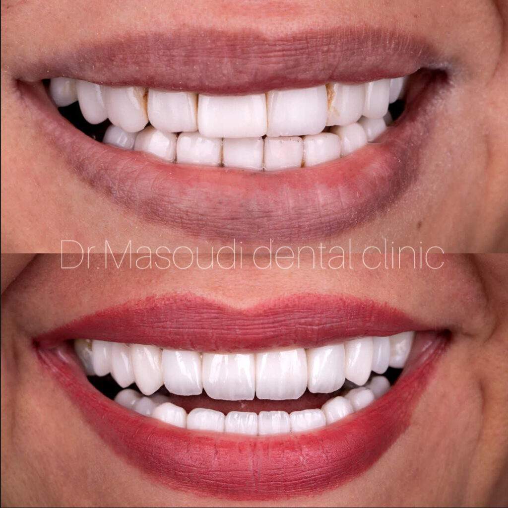 نمونه کار لمینت سرامیکی