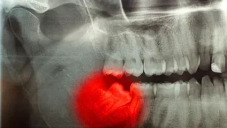دندان عقل نیمه نهفته