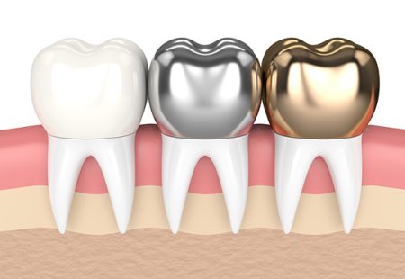 انواع روکش دندان در کرج