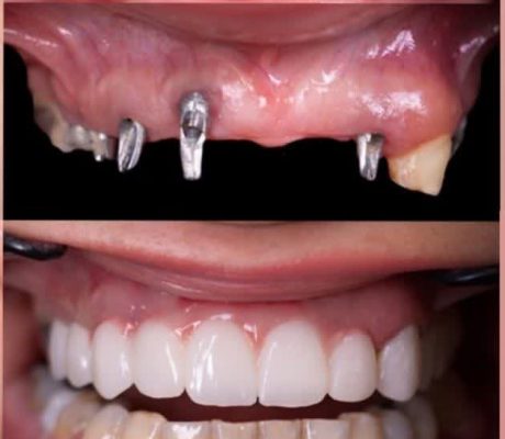 هزینه ایمپلنت دندان در سال ۱۴۰۴ در کرج